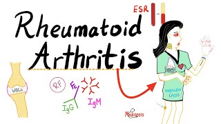 Rheumatoid Arthritis RA  Autoimmune Disease  Definition Etiologyamp Epidemiology  Rheumatology [upl. by Sclar]