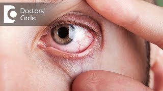 What causes visible red fine lines in eyes  Dr Elankumaran P [upl. by Nirrol112]