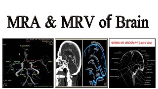 MRA amp MRV of Brain [upl. by Poore]