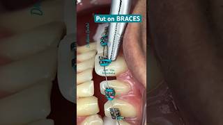 PUT On BRACES Brackets Orthodontist [upl. by Onavlis908]