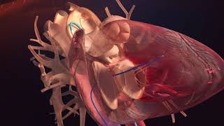 Opération cardiaque en 3D  Cathéter cardiaque [upl. by Jenifer]