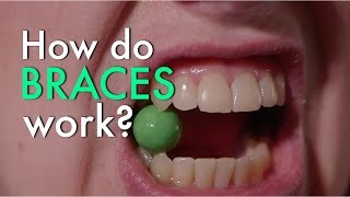 How Do Braces Work [upl. by Ainoloppa]