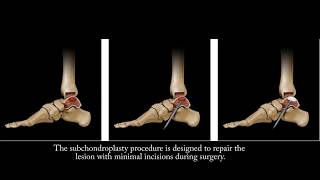 Minimally Invasive Foot Surgery  Zadek Procedure [upl. by Kape]