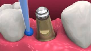 Smyl Manatee  Dental Implant Procedure [upl. by Eahsan]