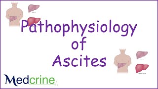 Differential Diagnosis of Ascites [upl. by Aggi509]