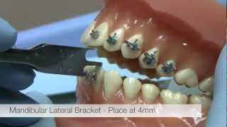 American Orthodontics Alexander LTS Brackets  Bracket Placement Video [upl. by Llerrom]