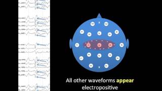 EEG Montages [upl. by Etteneg406]