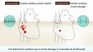 Arritmia  O que é isto [upl. by Aniretac268]