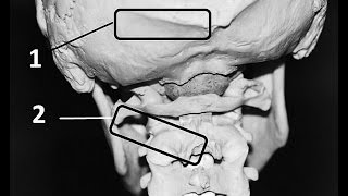 What is Occiptial Neuralgia [upl. by Peisch850]