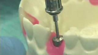 Placing Implant Abutments [upl. by Lorianna]