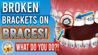 Broken Braces Brackets What You Need To Know [upl. by Jeu]