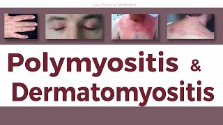 A Simplified Overview of Polymyositis amp Dermatomyositis  Clinical Features Diagnosis amp Treatment [upl. by Moritz]