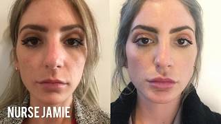 Before and After Micro Needling  Nurse Jamie [upl. by Ewart]