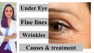 Fine lines  wrinkles under eye causes amp treatment Prevention  Dr Aanchal Panth [upl. by Airotkiv47]