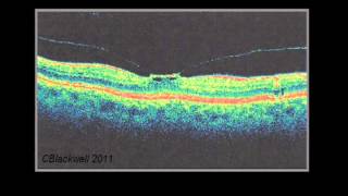 Eye Injections for Central Retinal Vein Occlusion CRVO [upl. by Eldnar]