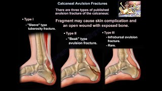 Plantar Fibromatosis  Everything You Need To Know  Dr Nabil Ebraheim [upl. by Stuppy]