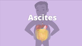 Ascites  Definition Causes Pathophysiology Diagnosis Management SAAG  Abdominal Distension [upl. by Dominy]