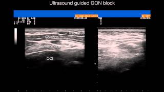 Ultrasound guided greater occipital nerve block [upl. by Eniawed710]