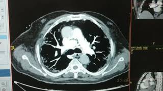 CT PULMONARY ANGIOGRAPHY [upl. by Normalie137]