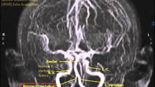 Noncontrast MRI cervical spine search pattern [upl. by Aihsenyt617]