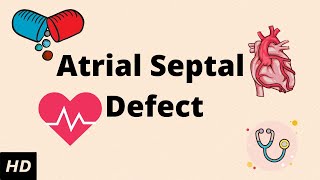 Dr Prem Sekar explains Device Closure Procedures for Simple holes in the Heart [upl. by Risan373]