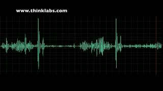 Myocardial Infarction  STEMI on ECG  Practice EKG [upl. by Deny]