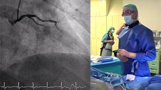 Left Atrial appendage closure with Amulet ™by Dr Adel Aminian [upl. by Niliac]