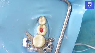 All Ceramic Crown Anterior Tooth Preparation [upl. by Rehpotsirk]