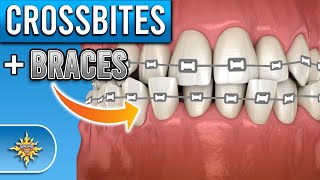 How Do BRACES Fix Crossbites [upl. by Thetisa]