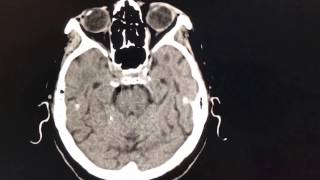 MCA Infarct Stroke [upl. by Sarkaria]