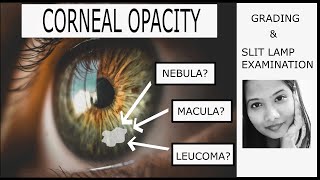 Corneal Transplant Penetrating Keratoplasty for Advanced Keratoconus and Corneal Infiltrates [upl. by Lowell103]