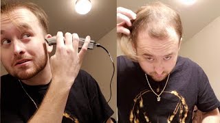 BALDING AT 20  Going Bald And Shaving My Head for good [upl. by Nylesor]