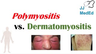 Idiopathic Inflammatory Myopathies  Polymyositis vs Dermatomyositis [upl. by Arabella]