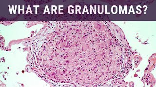 Medications for Chronic Granulomatous Disease [upl. by Anirtruc]