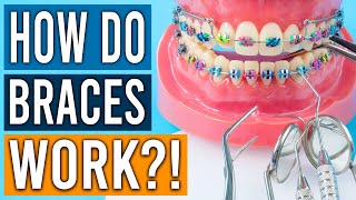 How Do Braces Work [upl. by Hakvir534]