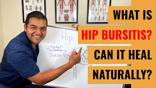 What Is Hip Bursitis Symptoms amp Diagnosis [upl. by Rotow]