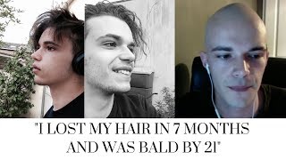 GOING BALD YOUNG Bald at 21 The Bald Cafe Podcast Ep 6 [upl. by Ja756]