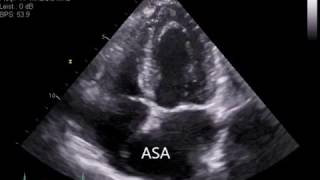 Atrial Septal Aneurysm ASA [upl. by March]