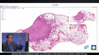 Granulomatosis with Polyangiitis pathophysiology symptoms treatment [upl. by Bussy]