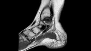 Ankle MRI anatomy [upl. by Garlanda190]