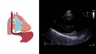 Mastering important TEE views transesophageal echocardiography [upl. by Clem]