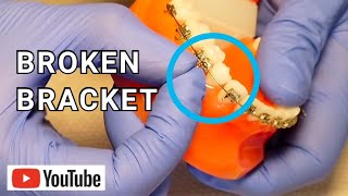 Broken Braces Broken Loose or Sliding Bracket What To Do [upl. by Nonnahsed]