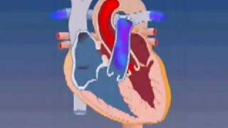 Ventricular Septal Defect Animation [upl. by Colpin]