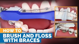 How to Brush amp Floss with Braces [upl. by Adnohsal]