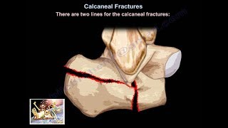 Calcaneal Avulsion Fractures  Everything You Need To Know  Dr Nabil Ebraheim [upl. by Einallem]