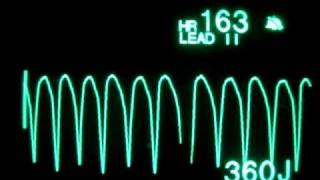 Pulseless Ventricular Tachycardia pVT  Monophasic Defibrillation at 360 Joules [upl. by Meesak]