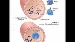 Systemic Lupus Erythrematosus SLE [upl. by Edieh]