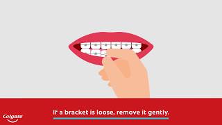 How to Fix a Broken Braces Bracket [upl. by Aneala]