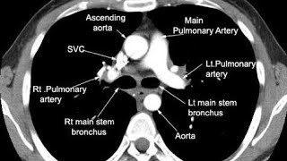 What is CT Angiography Test [upl. by Deirdra]