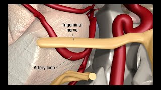 Treatment for Trigeminal Neuralgia UCSF Neurosurgery [upl. by Oinesra]